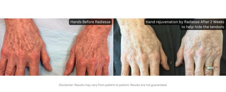 Hand rejuvenation by Radiesse® After 2 Weeks. Radiesse® was injected to help hide the tendons