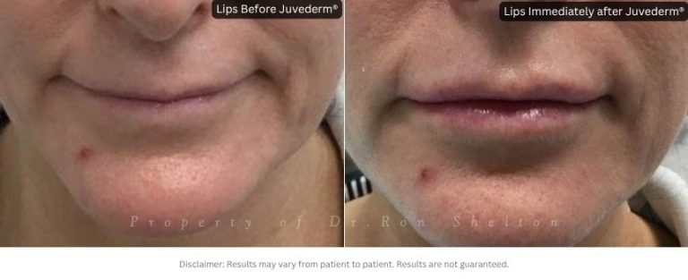 Lips Immediately after Juvederm®. She did not want to look unnatural and was very happy.