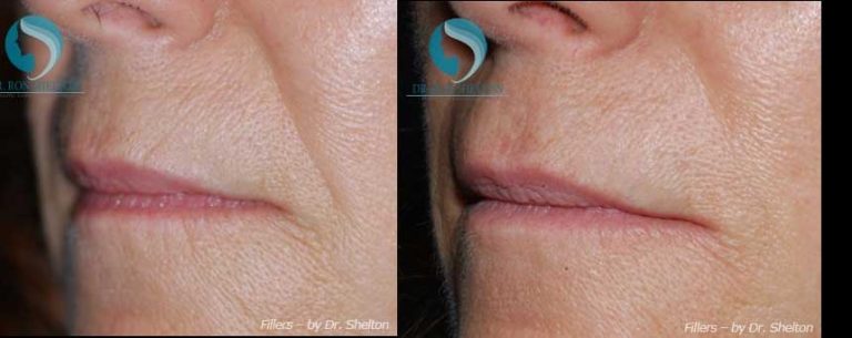 Lip lines and smile folds after Juvederm®