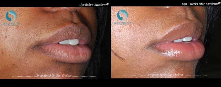 Lips 3 weeks after Juvederm®