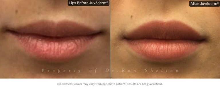 Lips treated with Juvéderm® Filler