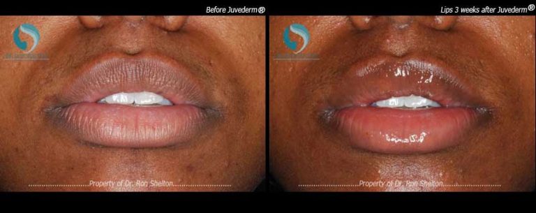 Lips 3 weeks after Juvederm®