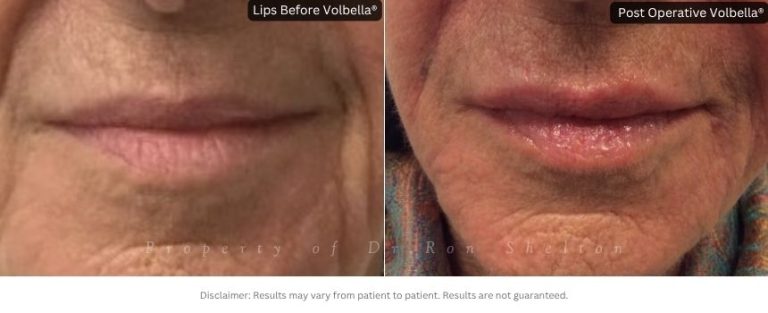 Post Operative Volbella®