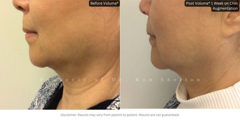 Post Voluma® 1 Week on Chin Augmentation