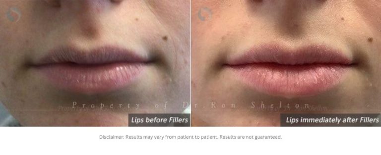 Lips Immediately after Volbella®