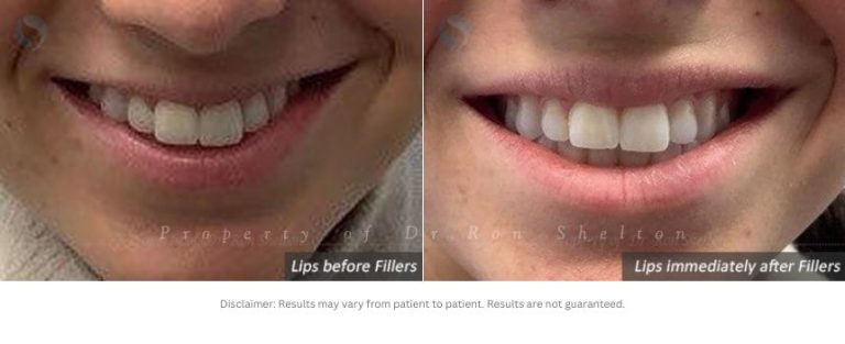 Above patient in her early 20s wanted to have a fuller upper lip because it disappeared on her when smiling widely but needed to look natural at rest. The after photos are immediately after treatment. Placing just the right amount to improve without looking unnatural involves gentle, slow delivery and meticulous technique.