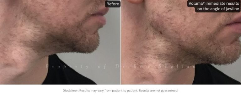 Voluma® immediate results on the angle of jawline