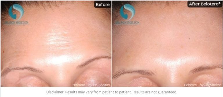 Belotero® on the forehead