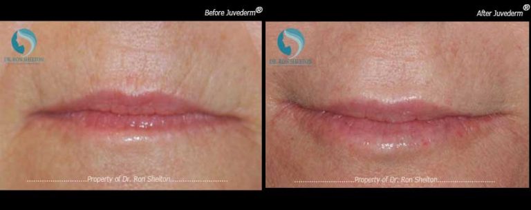 Juvederm® for Lip Augmentation