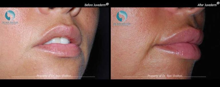 Lips 3 weeks after Juvederm®