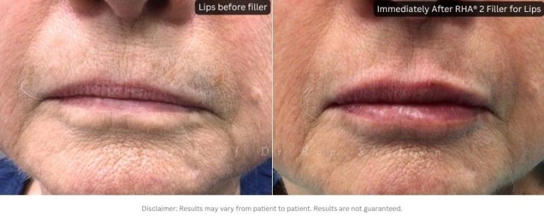 Immediately After RHA® 2 Filler for Lips