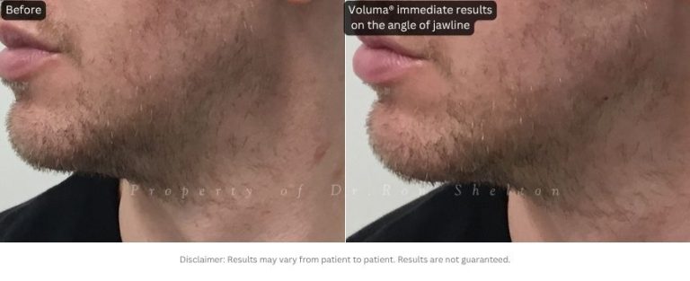Voluma® immediate results on the angle of jawline