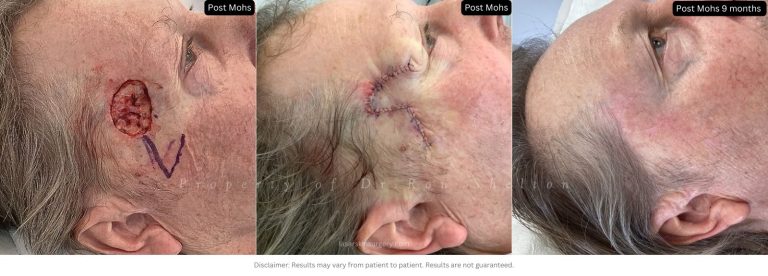 Post Mohs 9 months on the temples