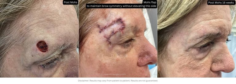 A flap was done to keep the eyebrows symmetrically in the same position without elevating this side.