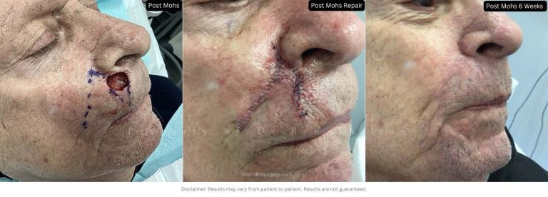 Post mohs 6 weeks on the lip