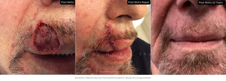 Post Mohs 10 years