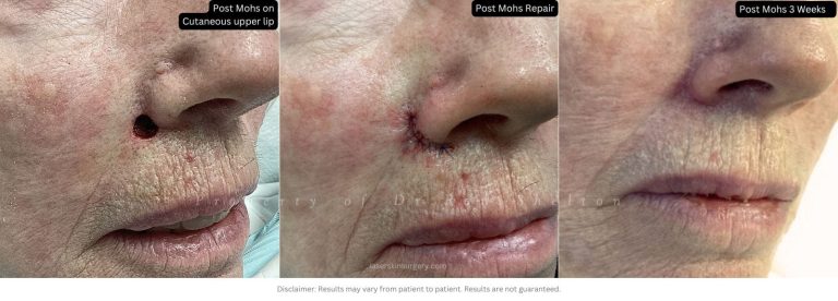 Post mohs 3 weeks on Cutaneous upper lip