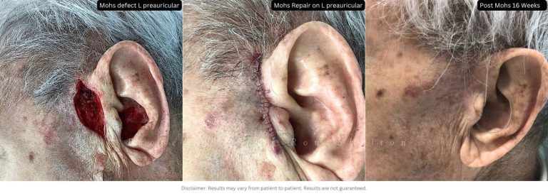 4 months post-Mohs, proving that healing and great outcomes are possible at any age.