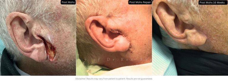 Post Mohs 16 Weeks on the Cheek