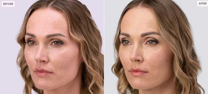 RHA-dynamic-volume-for-midface-volume-loss-c