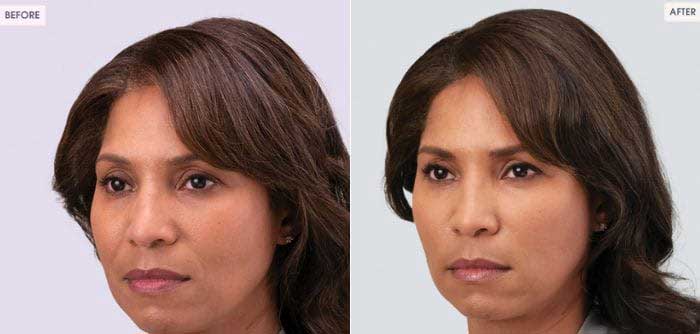 RHA-dynamic-volume-for-midface-volume-loss-c