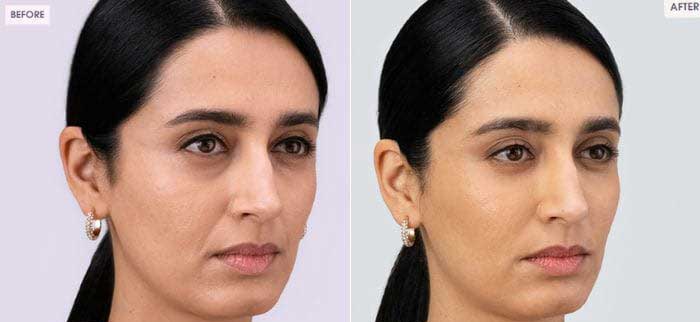 RHA-dynamic-volume-for-midface-volume-loss-c