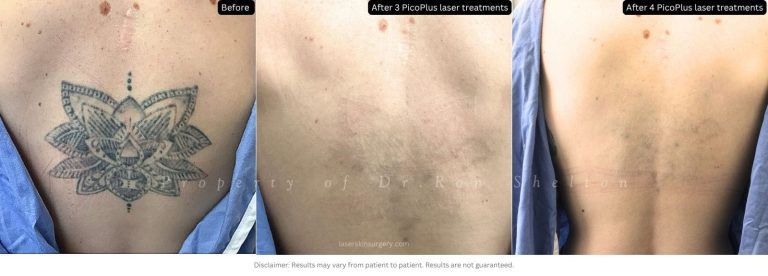 Steady progress with PicoPlus Laser tattoo removal. The tattoo has faded beautifully, and the patient was happy to stop treatments after her 4th session.