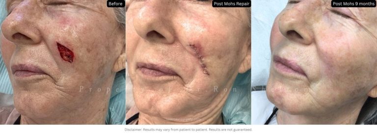 Post Mohs 9 months on the cheek