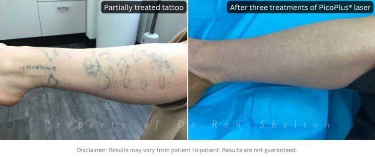 Years after three PicoPlus® laser treatments on a previously partially treated tattoo