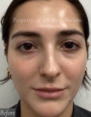 before fraxel dual laser
