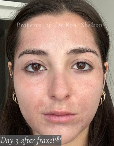 day 3 after fraxel