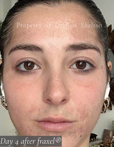 day 4 after fraxel