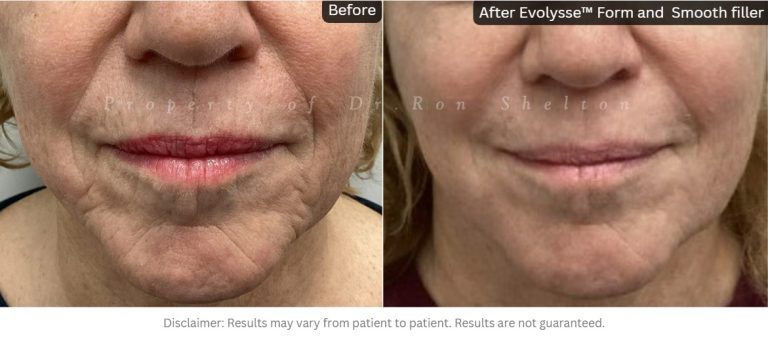 Evolysse™ Form and Evolysse™ Smooth was used to soften her lines. No laser was used.