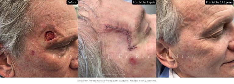 Post Mohs 3.25 Years