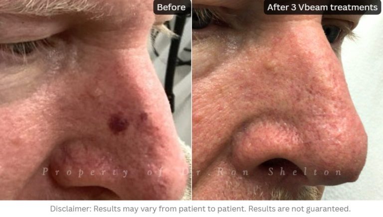 Right nose - Vbeam treatment for blood vessels