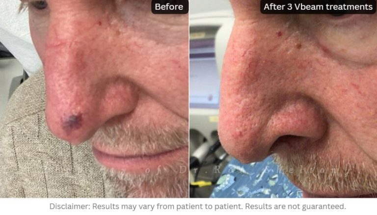 Left nose - Vbeam laser for acquired blood vessel growths on the nose