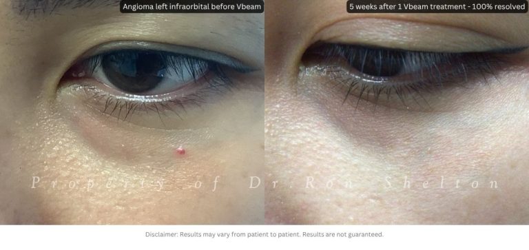 Angioma resolved 5 weeks after 1 Vbeam treatment
