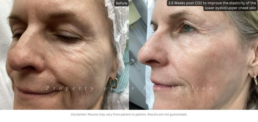 3.5 Weeks post CO2 to improve the elasticity of the lower eyelid/upper cheek skin