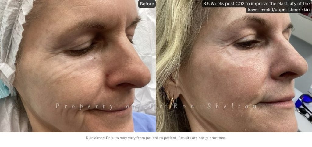 3.5 Weeks post CO2 to improve the elasticity of the lower eyelid/upper cheek skin