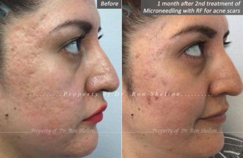 1-month-after-2nd-treatment-of-Microneedling-with-RF-for-acne-scars-3