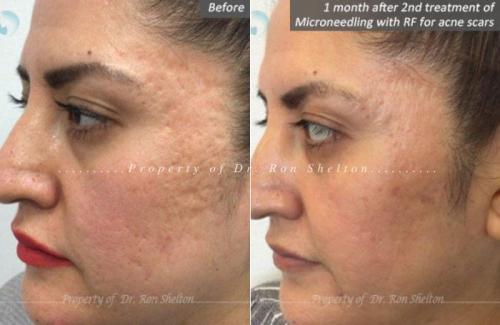 1-month-after-2nd-treatment-of-Microneedling-with-RF-for-acne-scars