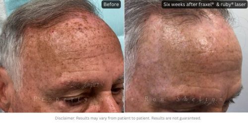 Six weeks after fraxel®  ruby® laser for brown spots