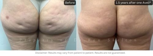 Excellent improvement in buttock cellulite1.5 years after one Aveli® treatment