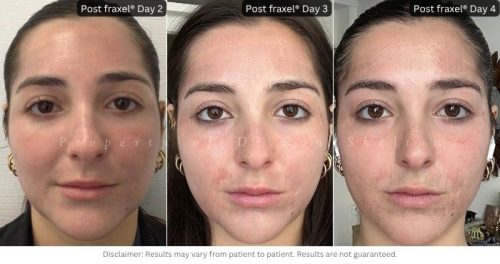 Redness begins to soften.