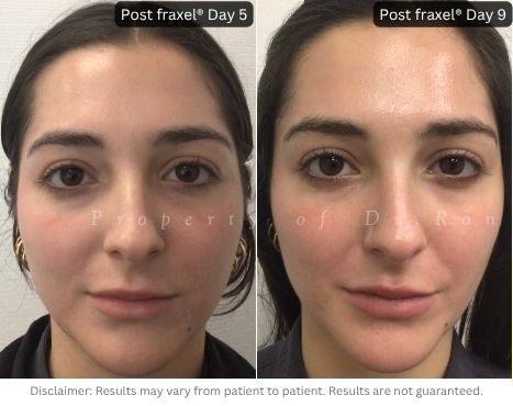 Noticeable improvement in texture, pore size, and overall skin brilliance following dual-wavelength Fraxel® treatment.