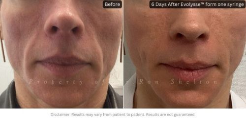 6 days after Evolysse™ Form one syringe