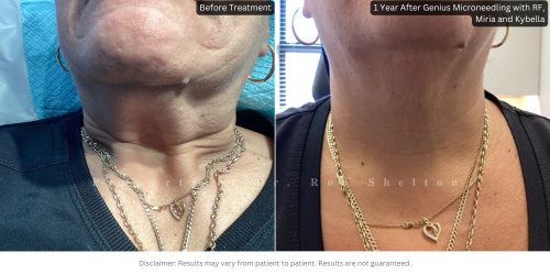 1 Year After Genius Microneedling with RF, Miria and Kybella for neck wrinkles