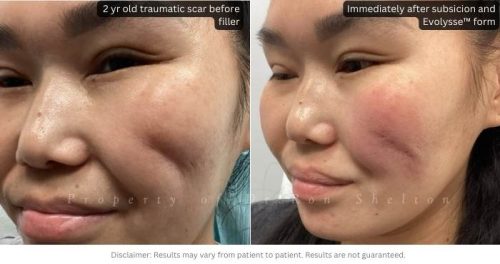 Evolysse Form for traumatic treatment