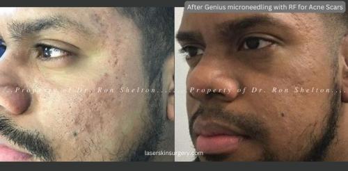 Improvement-in-acne-scars-after-Genius-microneedling-with-radiofrequency