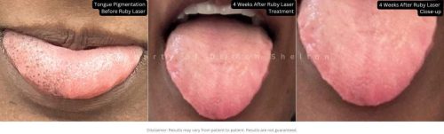 4 Weeks After Ruby Laser Treatment for Tongue Pigmentation